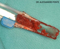 Ustomed Safescraper, TWIST, curved, sterile, 3st | 85-802-002